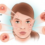 Header Types Of Acne 886x590